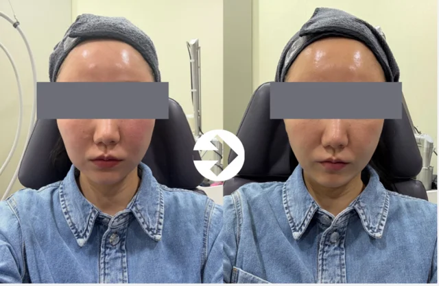 Facial comparison 3: chin and cheeks at Seolreim Clinic. Facial comparison 3: chin and cheeks. The caption describes the arrangement of the earlier and later views. Eyes retain the clinic’s supplied privacy coverings where visible. Follow-up timing is not supplied.