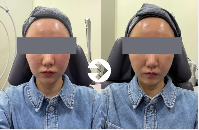 Facial comparison 3: chin and cheeks at Seolreim Clinic. Facial comparison 3: chin and cheeks. The caption describes the arrangement of the earlier and later views. Eyes retain the clinic’s supplied privacy coverings where visible. Follow-up timing is not supplied.
