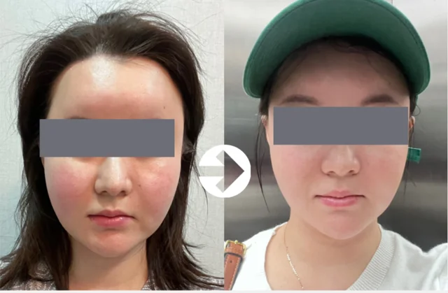 Facial comparison 4: skin tone and contours at Seolreim Clinic. Facial comparison 4: skin tone and contours. The caption describes the arrangement of the earlier and later views. Eyes retain the clinic’s supplied privacy coverings where visible. Follow-up timing is not supplied.