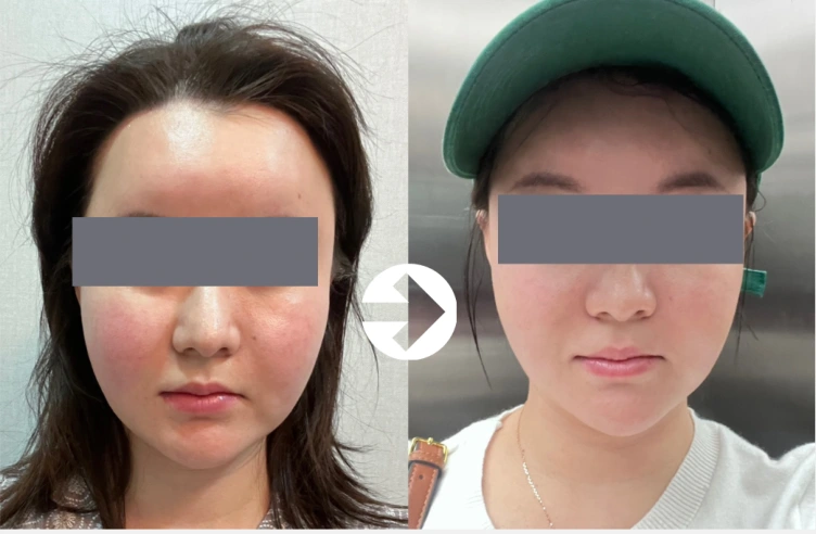 Facial comparison 4: skin tone and contours at Seolreim Clinic. Facial comparison 4: skin tone and contours. The caption describes the arrangement of the earlier and later views. Eyes retain the clinic’s supplied privacy coverings where visible. Follow-up timing is not supplied.