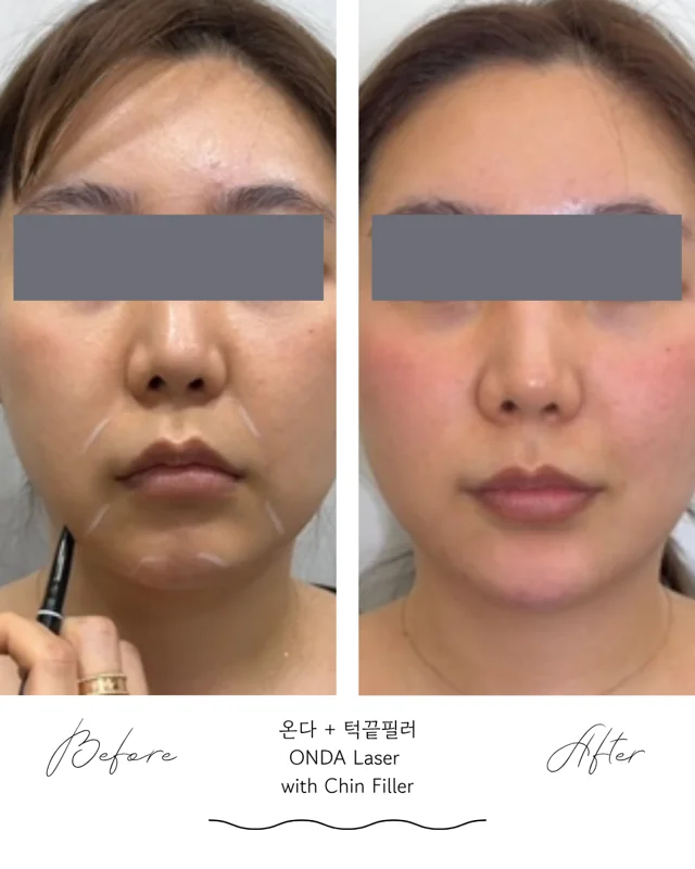 ONDA and chin filler: front comparison at Seolreim Clinic. ONDA and chin filler: front comparison. Before on the left and after on the right. Eyes retain the clinic’s supplied privacy coverings where visible. Follow-up timing is not supplied.