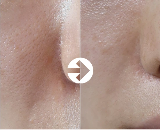 Silky Pore Injection: cheek texture at Seolreim Clinic. Silky Pore Injection: cheek texture. The caption describes the arrangement of the earlier and later views. Eyes retain the clinic’s supplied privacy coverings where visible. Follow-up timing is not supplied.