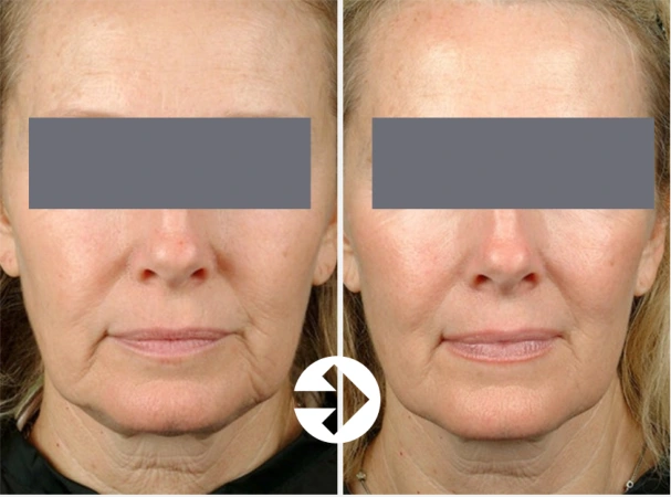 Thermage FLX: cheeks and lower face at Seolreim Clinic. Thermage FLX: cheeks and lower face. The caption describes the arrangement of the earlier and later views. Eyes retain the clinic’s supplied privacy coverings where visible. Follow-up timing is not supplied.