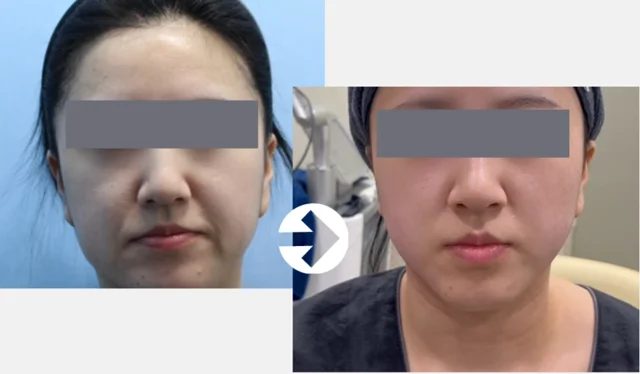 Ulthera: front facial comparison at Seolreim Clinic. Ulthera: front facial comparison. The caption describes the arrangement of the earlier and later views. Eyes retain the clinic’s supplied privacy coverings where visible. Follow-up timing is not supplied.