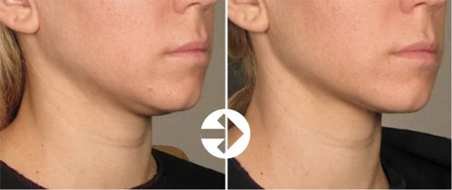 Ulthera: angled jawline comparison at Seolreim Clinic. Ulthera: angled jawline comparison. The caption describes the arrangement of the earlier and later views. Eyes retain the clinic’s supplied privacy coverings where visible. Follow-up timing is not supplied.