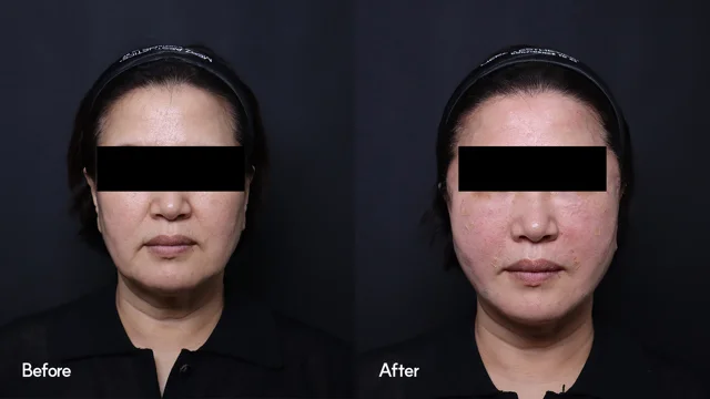 High-Fit lifting: front facial comparison at Seoul Leaguer Dermatology Clinic. SeouLeaguer Dermatology: High-Fit lifting: front facial comparison. Front photographs, before on the left and after on the right. Follow-up timing is not supplied.