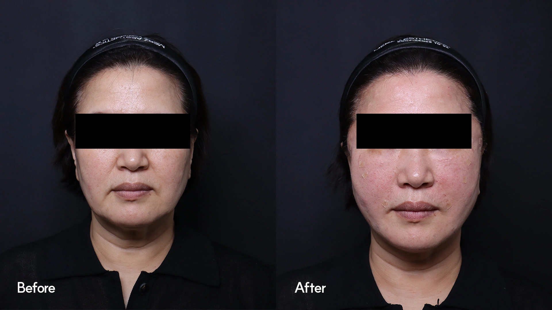 High-Fit lifting: front facial comparison at Seoul Leaguer Dermatology Clinic. SeouLeaguer Dermatology: High-Fit lifting: front facial comparison. Front photographs, before on the left and after on the right. Follow-up timing is not supplied.
