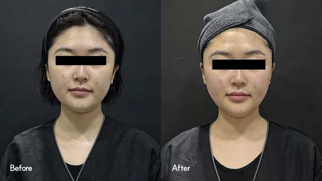 Silhouette Soft: front facial comparison at Seoul Leaguer Dermatology Clinic. SeouLeaguer Dermatology: Silhouette Soft: front facial comparison. Front photographs, before on the left and after on the right. Follow-up timing is not supplied.