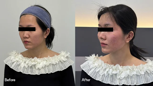 Face contouring: angled and profile views at Seoul Leaguer Dermatology Clinic. SeouLeaguer Dermatology: Face contouring: angled and profile views. Angled photographs, before on the left and after on the right. Follow-up timing is not supplied.