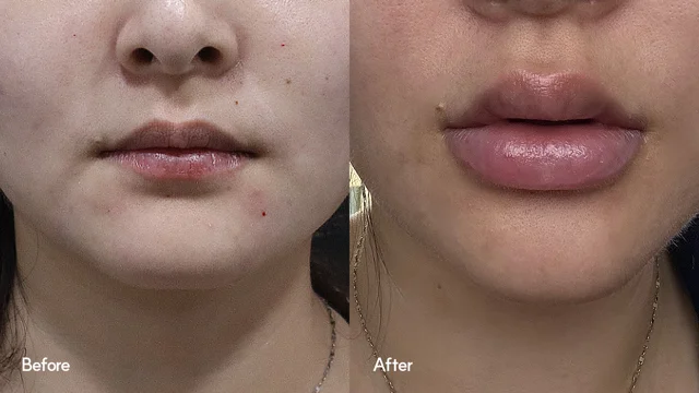 Lip filler: close-up comparison at Seoul Leaguer Dermatology Clinic. SeouLeaguer Dermatology: Lip filler: close-up comparison. Lip close-up photographs, before on the left and after on the right. Follow-up timing is not supplied.