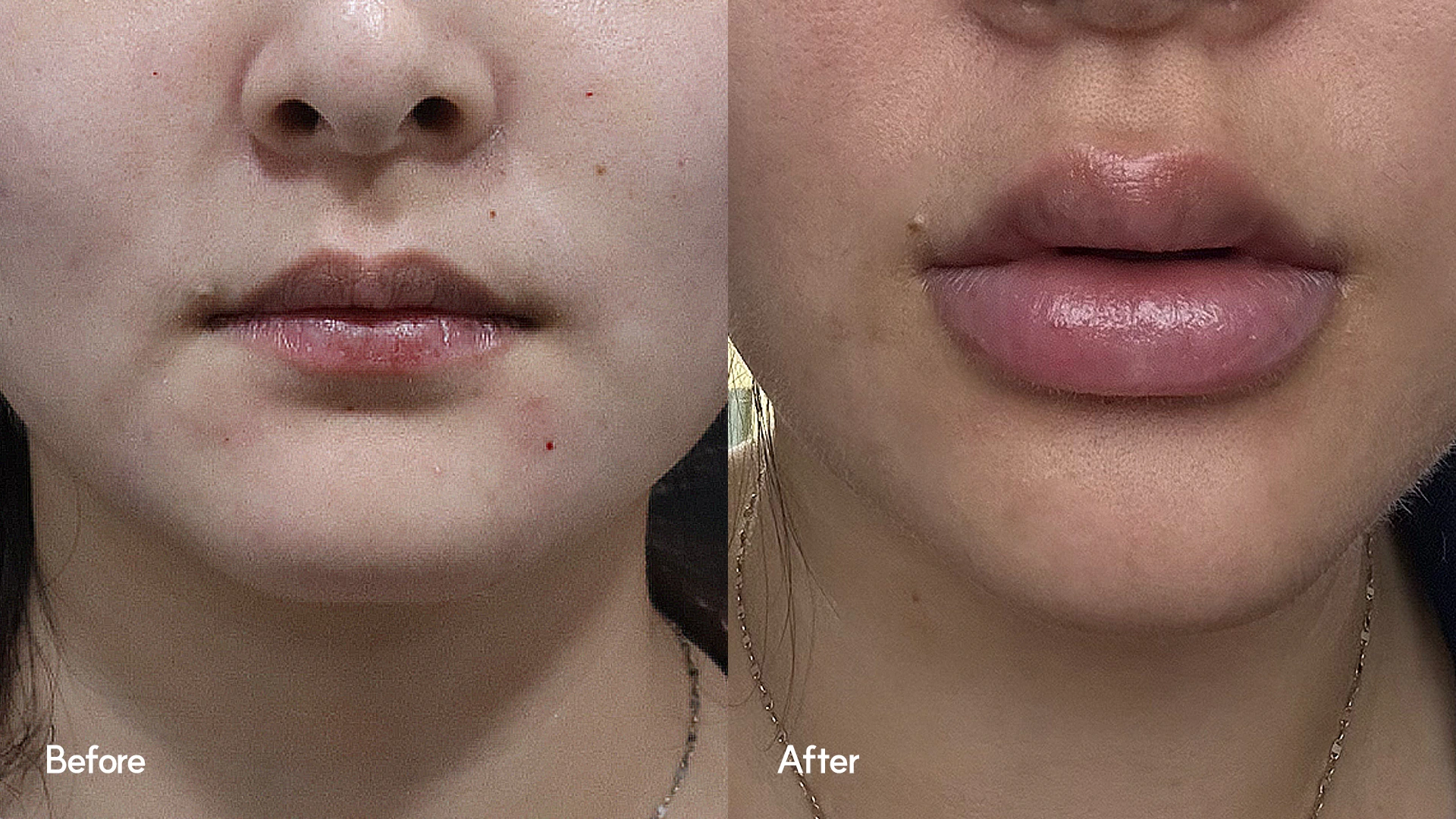 Lip filler: close-up comparison at Seoul Leaguer Dermatology Clinic. SeouLeaguer Dermatology: Lip filler: close-up comparison. Lip close-up photographs, before on the left and after on the right. Follow-up timing is not supplied.