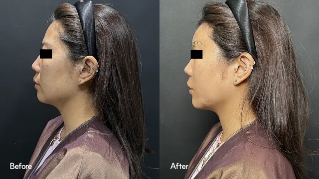 Face contouring: side-profile comparison at Seoul Leaguer Dermatology Clinic. SeouLeaguer Dermatology: Face contouring: side-profile comparison. Side-profile photographs, before on the left and after on the right. Follow-up timing is not supplied.
