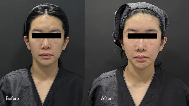 Face contouring: front facial comparison at Seoul Leaguer Dermatology Clinic. SeouLeaguer Dermatology: Face contouring: front facial comparison. Front photographs, before on the left and after on the right. Follow-up timing is not supplied.