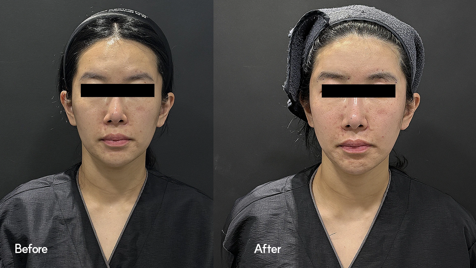 Face contouring: front facial comparison at Seoul Leaguer Dermatology Clinic. SeouLeaguer Dermatology: Face contouring: front facial comparison. Front photographs, before on the left and after on the right. Follow-up timing is not supplied.