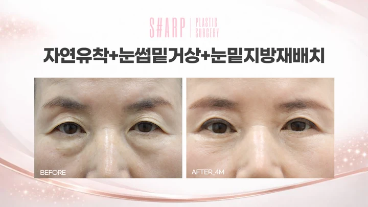 Combined eyelid and under-eye surgery — four months before and after at Sharp Plastic Surgery