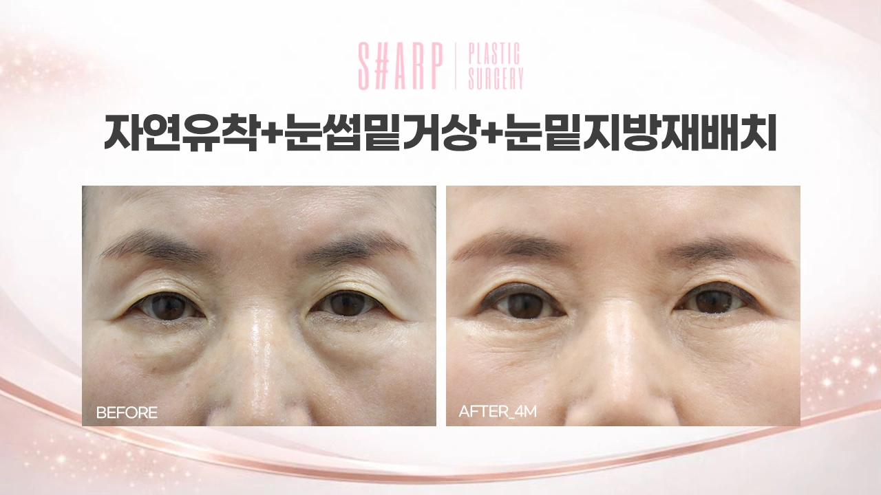 Combined eyelid and under-eye surgery — four months at Sharp Plastic Surgery — before left, after right
