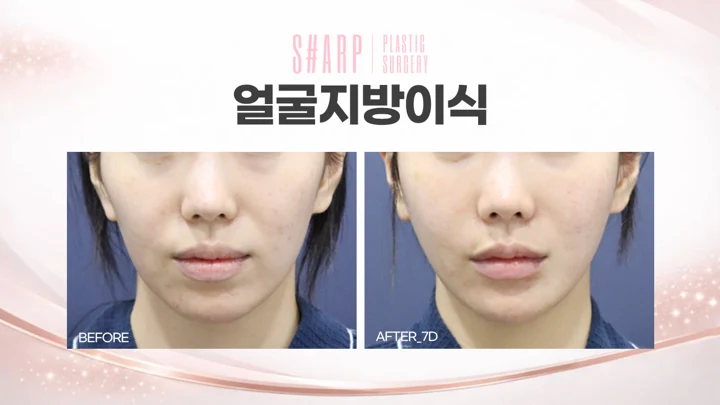 Facial fat grafting — seven days before and after at Sharp Plastic Surgery