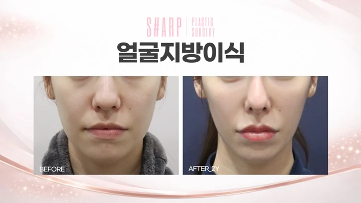 Facial fat grafting — two years before and after at Sharp Plastic Surgery