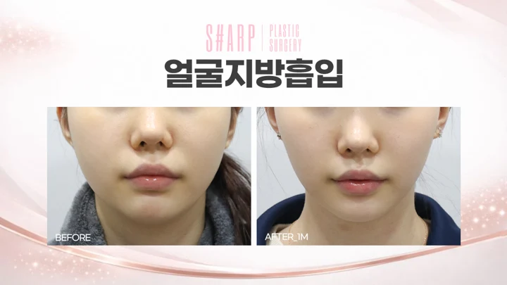 Facial liposuction from the front — one month before and after at Sharp Plastic Surgery