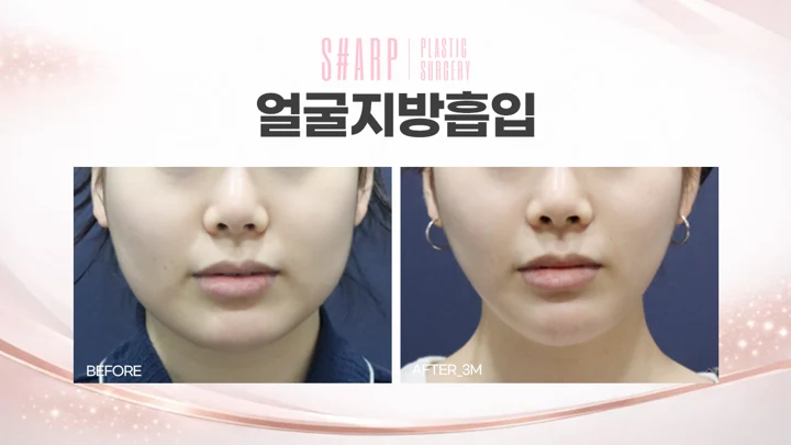 Facial liposuction from the front — three months before and after at Sharp Plastic Surgery