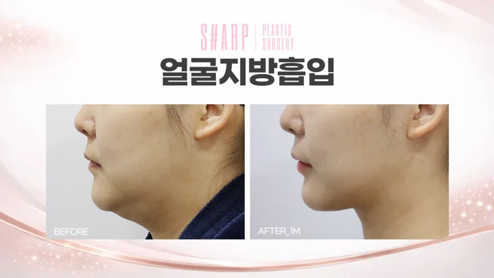 Facial liposuction in profile — one month before and after at Sharp Plastic Surgery