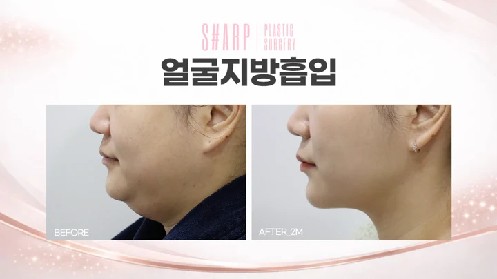 Facial liposuction in profile — two months before and after at Sharp Plastic Surgery
