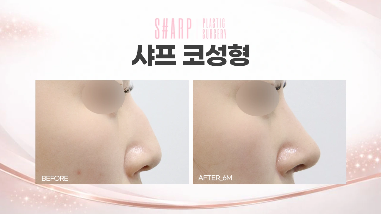 Rhinoplasty in profile — six months at Sharp Plastic Surgery — before left, after right