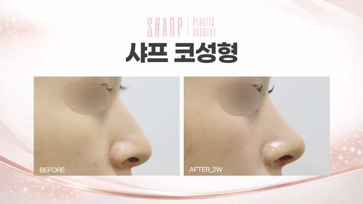 Rhinoplasty in profile — two weeks before and after at Sharp Plastic Surgery