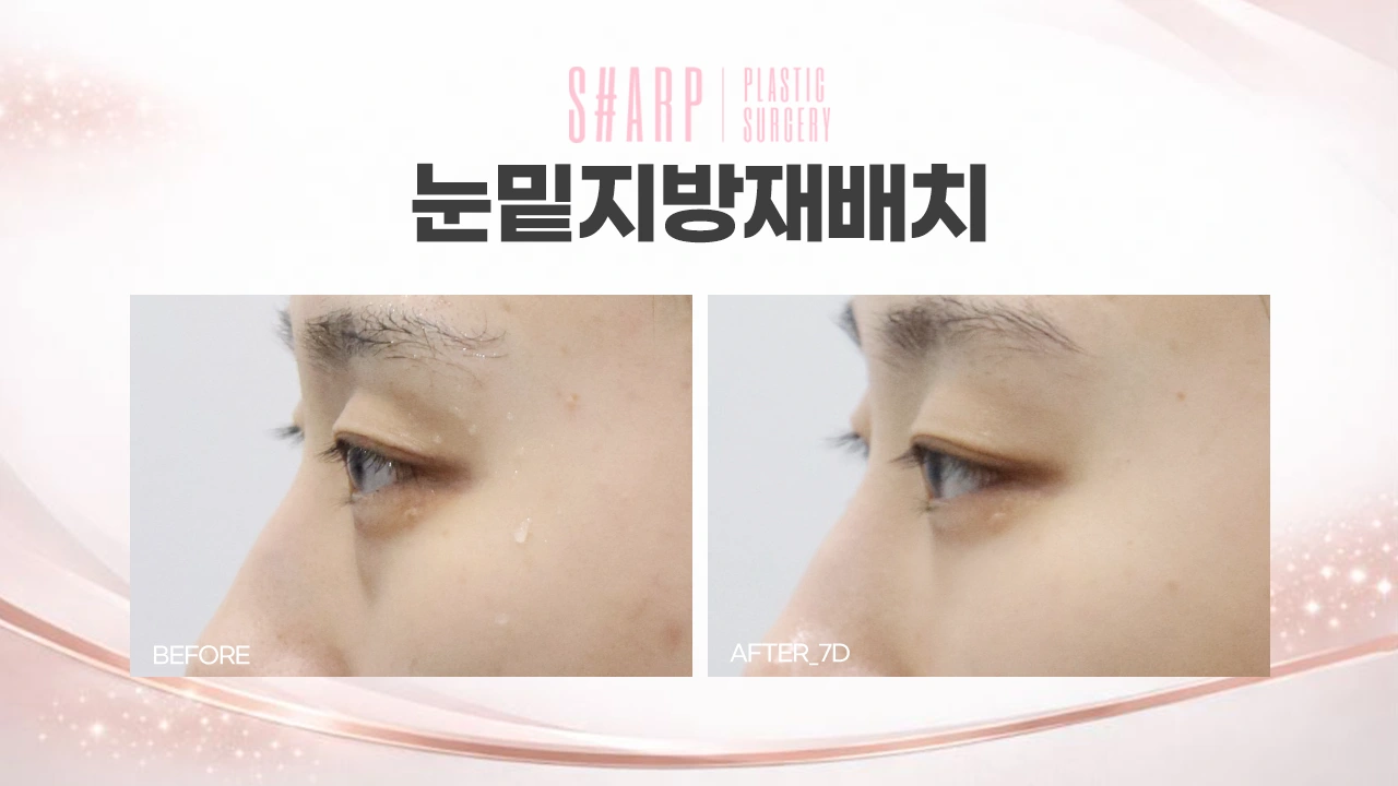 Under-eye fat repositioning — seven days at Sharp Plastic Surgery — before left, after right