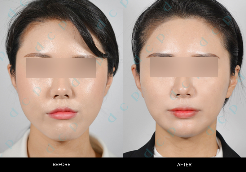 Facial profile and lower-face outline at Sinsa Oral & Maxillofacial Surgery. Frontal before-and-after comparison of the cheeks, lower-face width and chin — Sinsa collection, case 01. Original Dacapo branding and eye coverings are retained.