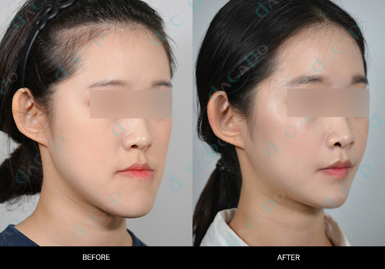 Cheek and jaw outline: an oblique comparison at Sinsa Oral & Maxillofacial Surgery. Oblique before-and-after comparison of the cheek, jawline and chin at an angle — Sinsa collection, case 02. Original Dacapo branding and eye coverings are retained.