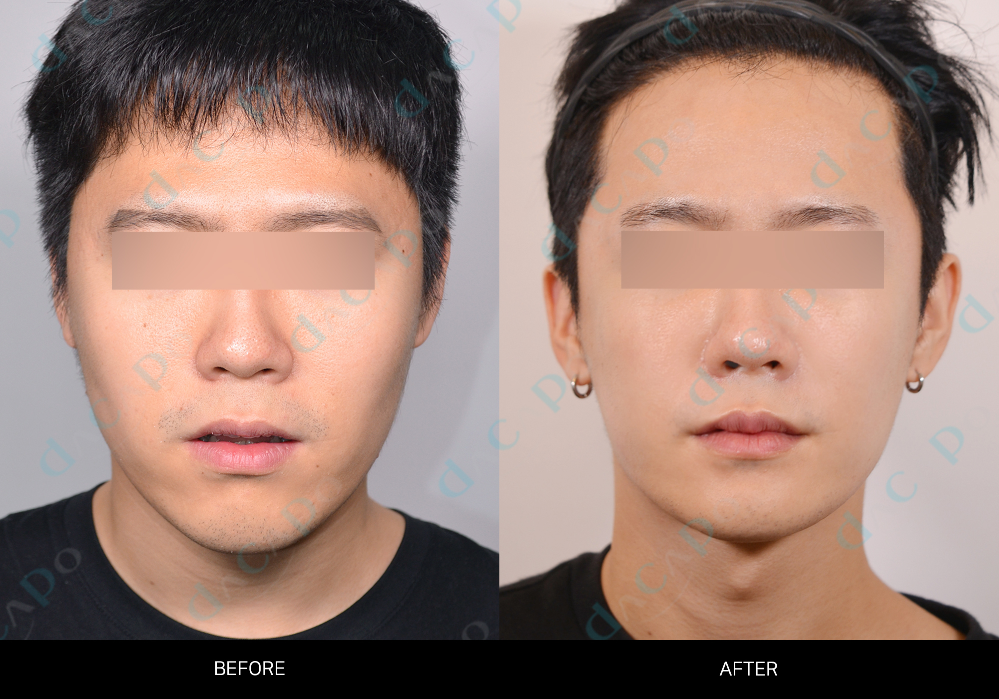 Chin and jaw profile across three views at Sinsa Oral & Maxillofacial Surgery. Frontal before-and-after comparison of the cheeks, lower-face width and chin — Sinsa collection, case 03. Original Dacapo branding and eye coverings are retained.
