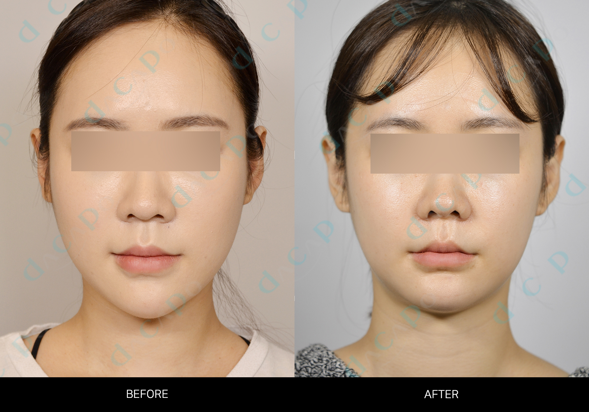 Lower-face proportions from front to profile at Sinsa Oral & Maxillofacial Surgery. Frontal before-and-after comparison of the cheeks, lower-face width and chin — Sinsa collection, case 04. Original Dacapo branding and eye coverings are retained.