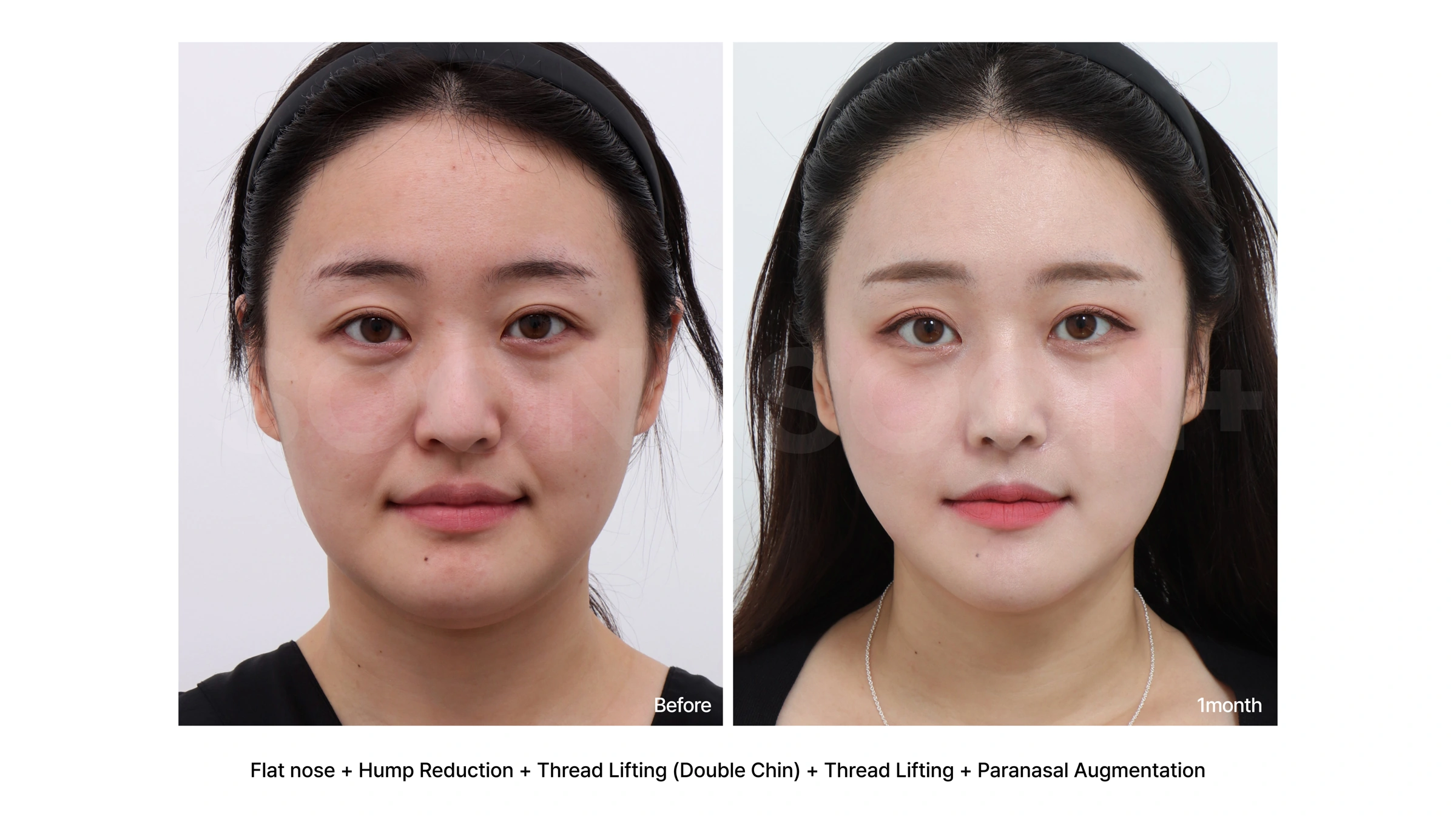Rhinoplasty with thread lifting and paranasal augmentation at Soonplus Plastic Surgery. Soonplus Plastic Surgery, Seoul: rhinoplasty with thread lifting and paranasal augmentation, front views, with before on the left and after on the right. The source labels the follow-up as 1 month.
