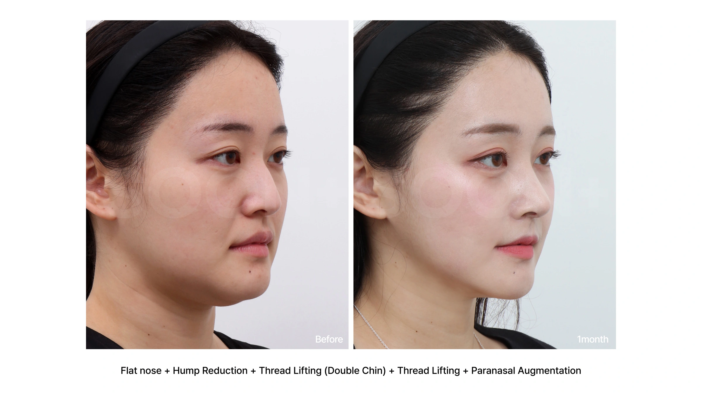 Rhinoplasty with thread lifting and paranasal augmentation at Soonplus Plastic Surgery. Soonplus Plastic Surgery, Seoul: rhinoplasty with thread lifting and paranasal augmentation, angled views, with before on the left and after on the right. The source labels the follow-up as 1 month.