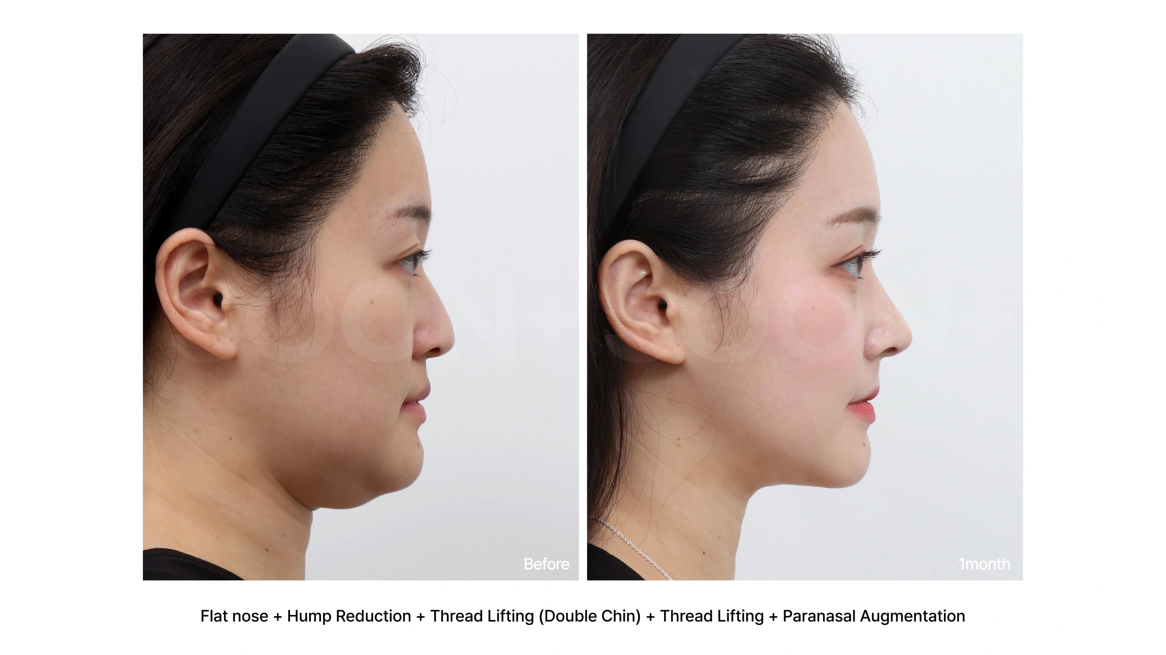 Rhinoplasty with thread lifting and paranasal augmentation at Soonplus Plastic Surgery. Soonplus Plastic Surgery, Seoul: rhinoplasty with thread lifting and paranasal augmentation, profile views, with before on the left and after on the right. The source labels the follow-up as 1 month.