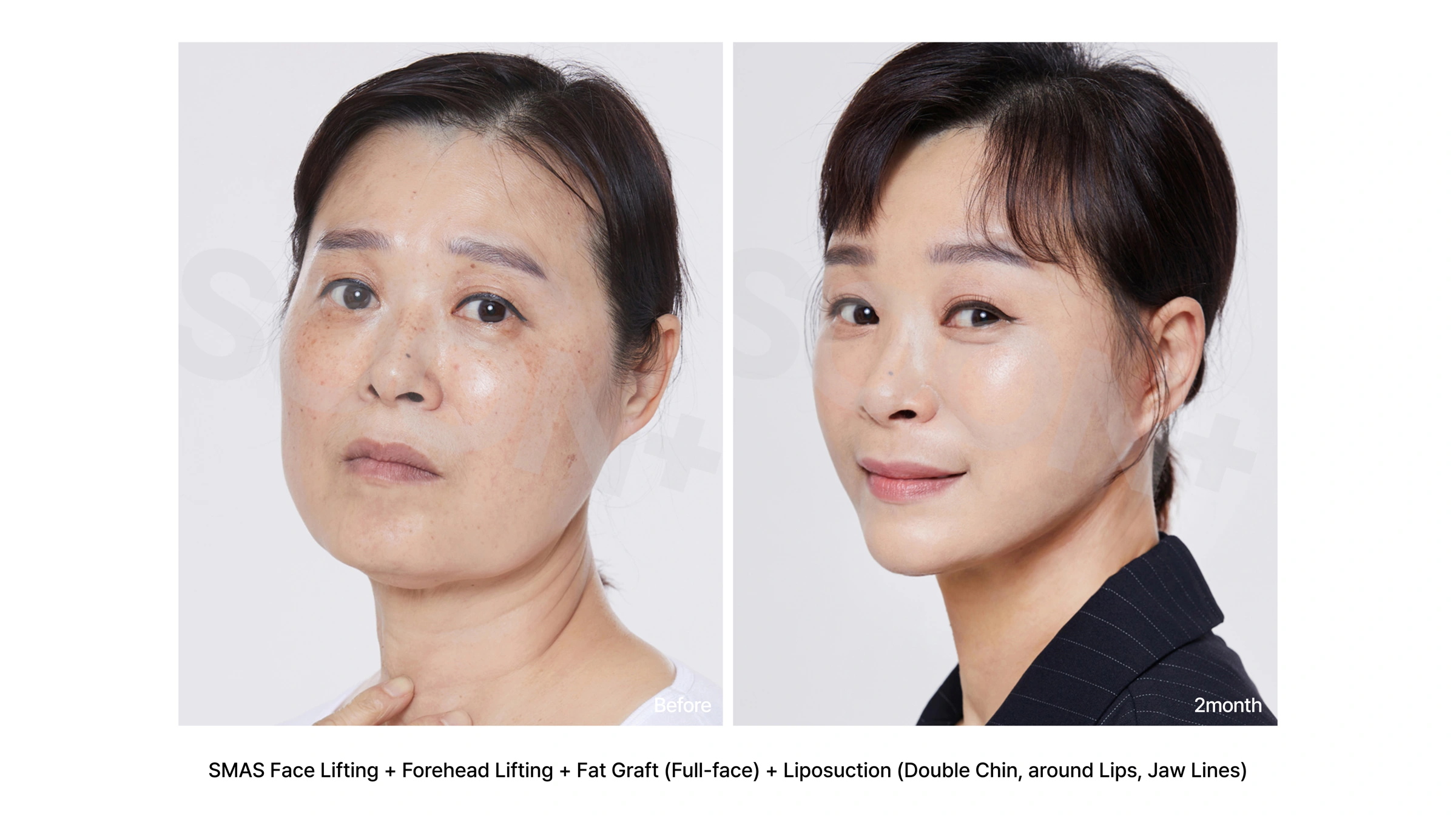 SMAS facelift, forehead lift and facial fat grafting at Soonplus Plastic Surgery. Soonplus Plastic Surgery, Seoul: smas facelift, forehead lift and facial fat grafting, angled facial views, with before on the left and after on the right. The source labels the follow-up as 2 months.
