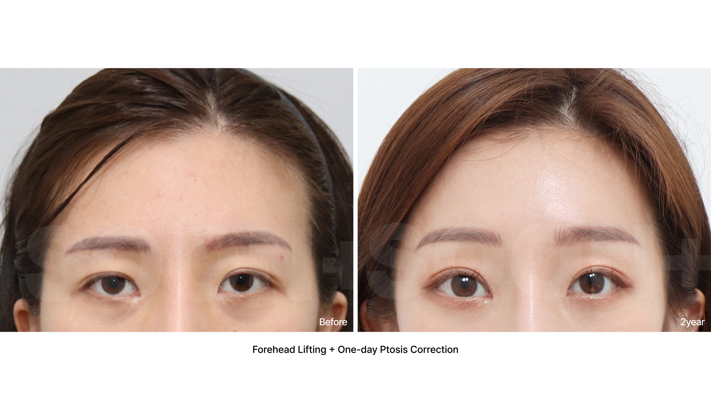 Forehead lift with ptosis correction at Soonplus Plastic Surgery. Soonplus Plastic Surgery, Seoul: forehead lift with ptosis correction, upper-face views, with before on the left and after on the right. The source labels the follow-up as 2 years.