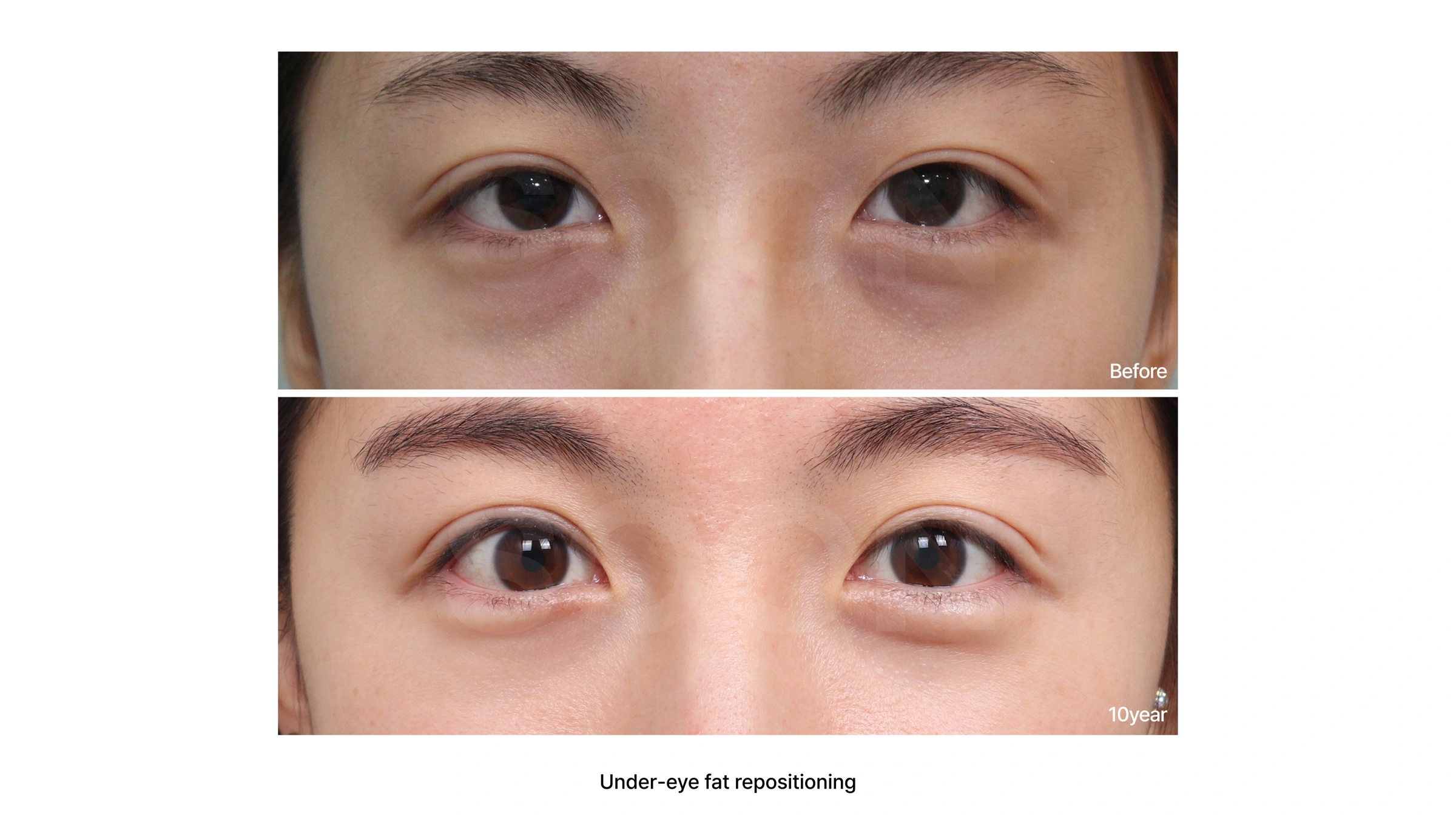 Under-eye fat repositioning at Soonplus Plastic Surgery. Soonplus Plastic Surgery, Seoul: under-eye fat repositioning, close-up eye views, with before above and after below. The source labels the follow-up as 10 years.