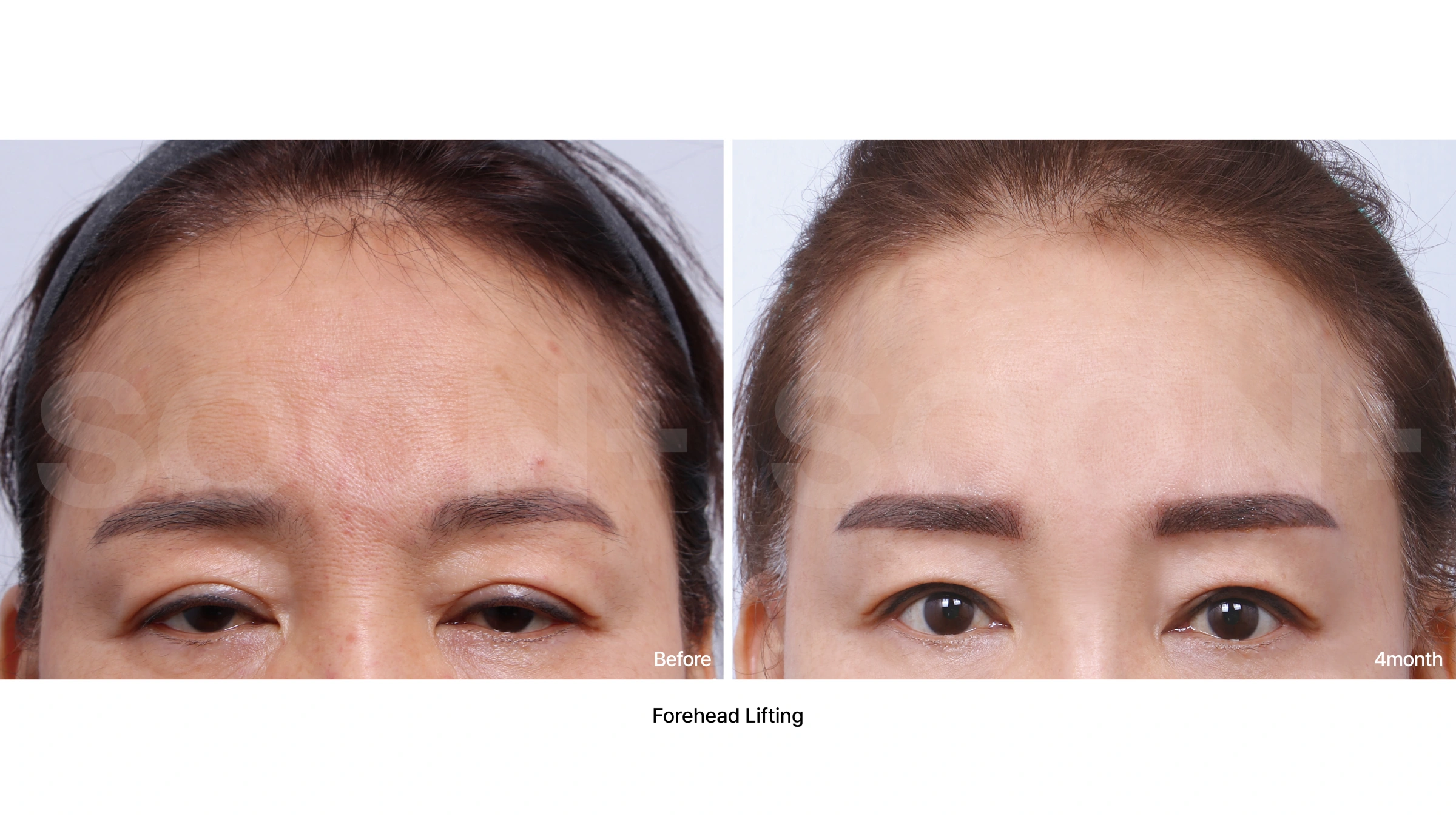 Forehead lift — upper-face comparison 01 at Soonplus Plastic Surgery. Soonplus Plastic Surgery, Seoul: forehead lift — upper-face comparison 01, upper-face views, with before on the left and after on the right. The source labels the follow-up as 4 months.