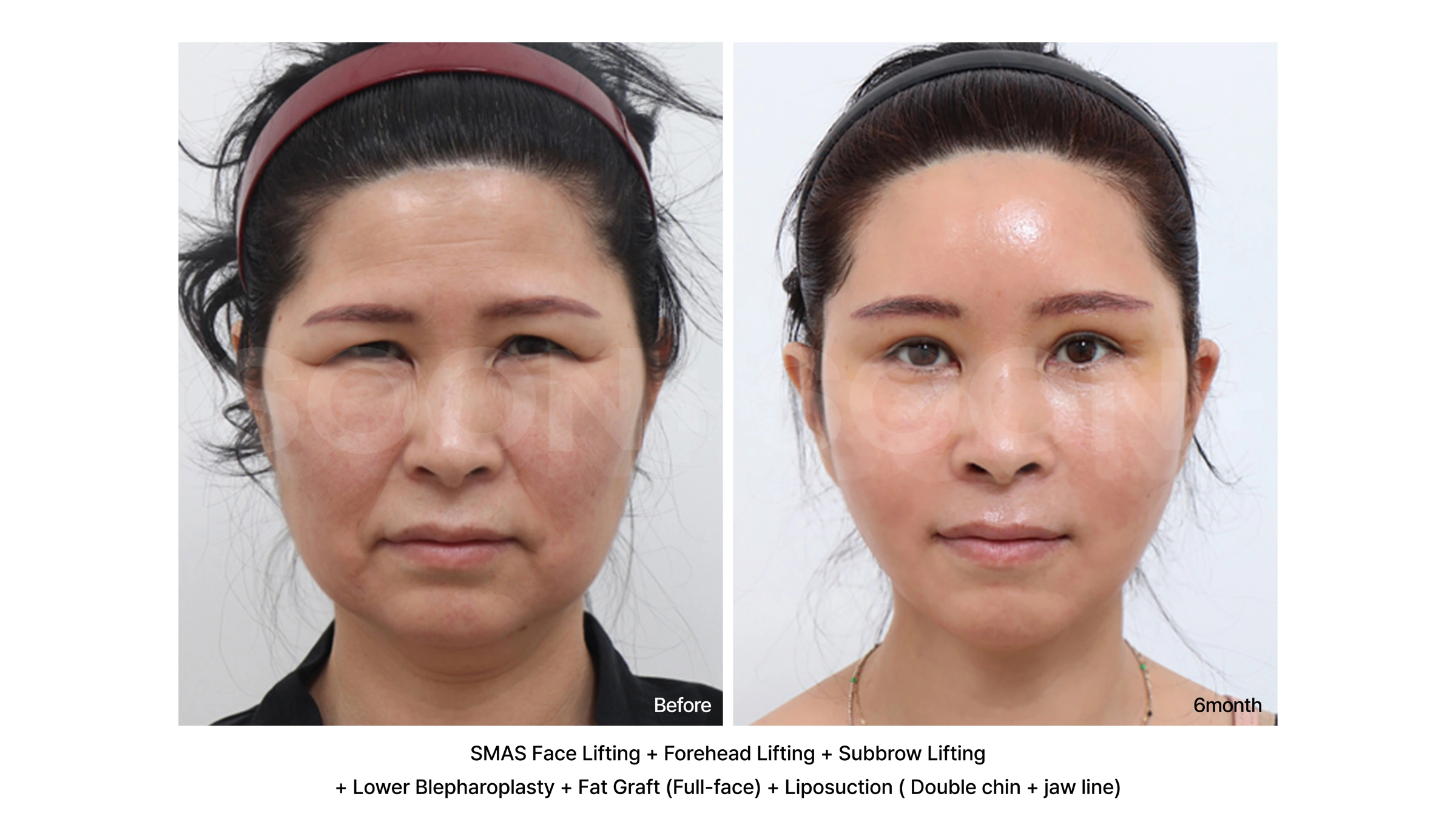 Facelift with sub-brow lift and lower eyelid surgery at Soonplus Plastic Surgery. Soonplus Plastic Surgery, Seoul: facelift with sub-brow lift and lower eyelid surgery, front facial views, with before on the left and after on the right. The source labels the follow-up as 6 months.