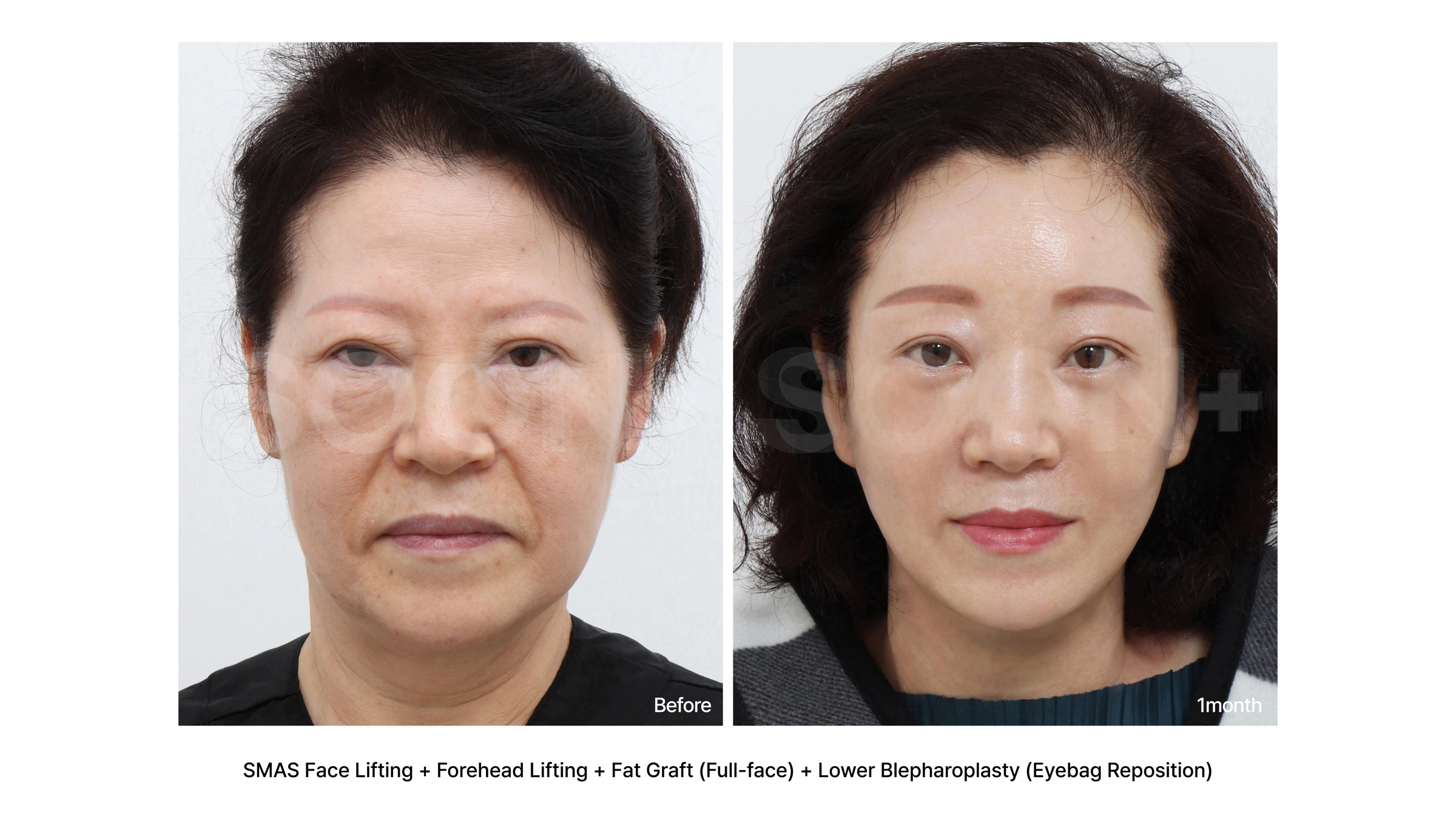 Facelift with lower eyelid surgery and fat grafting at Soonplus Plastic Surgery. Soonplus Plastic Surgery, Seoul: facelift with lower eyelid surgery and fat grafting, front facial views, with before on the left and after on the right. The source labels the follow-up as 1 month.