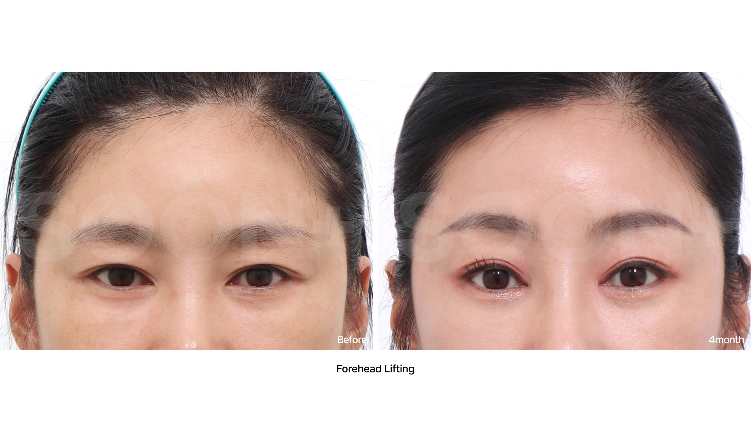 Forehead lift — upper-face comparison 02 at Soonplus Plastic Surgery. Soonplus Plastic Surgery, Seoul: forehead lift — upper-face comparison 02, upper-face views, with before on the left and after on the right. The source labels the follow-up as 4 months.