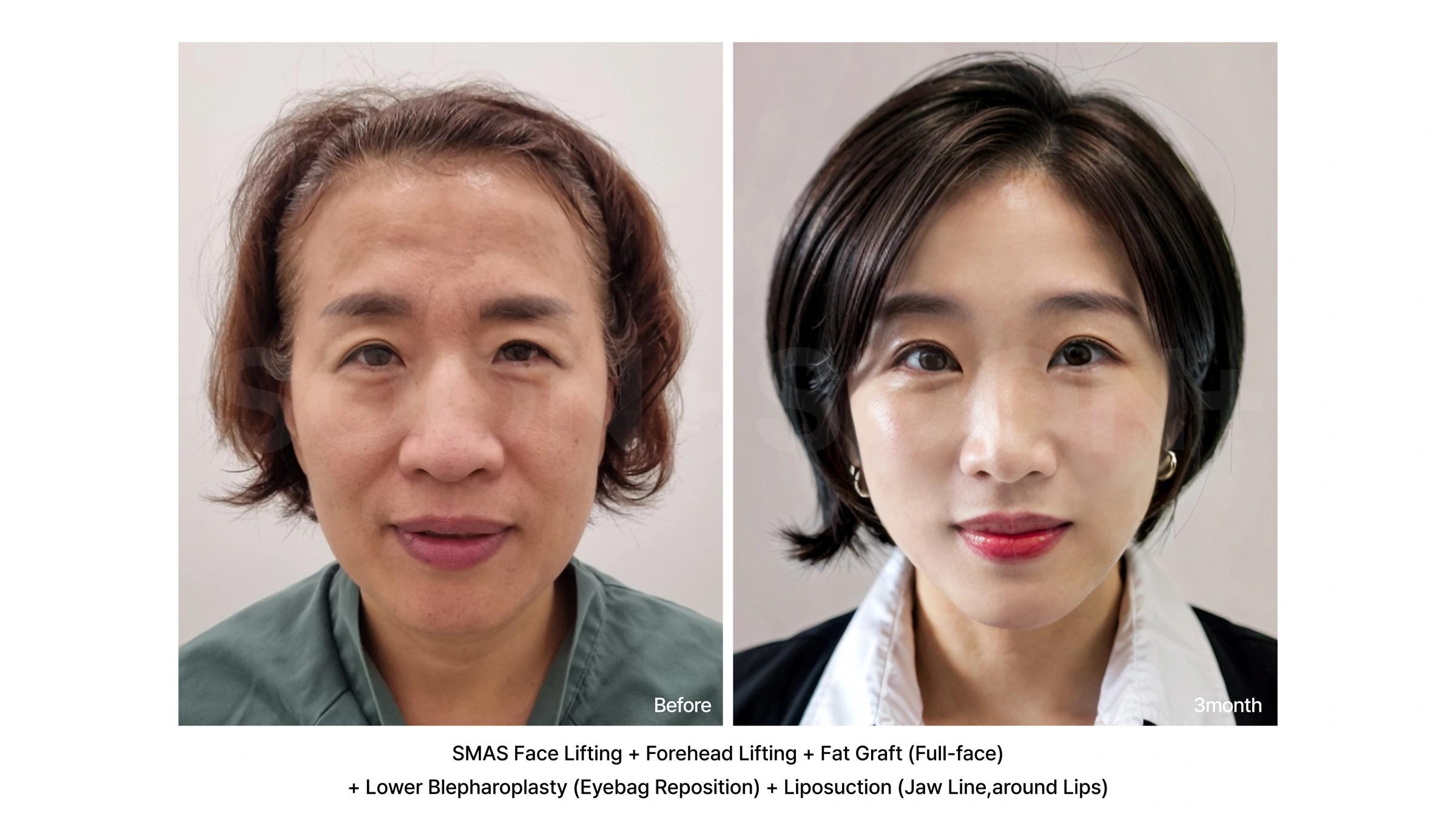 Facelift with eyelid surgery and facial liposuction at Soonplus Plastic Surgery. Soonplus Plastic Surgery, Seoul: facelift with eyelid surgery and facial liposuction, front facial views, with before on the left and after on the right. The source labels the follow-up as 3 months.