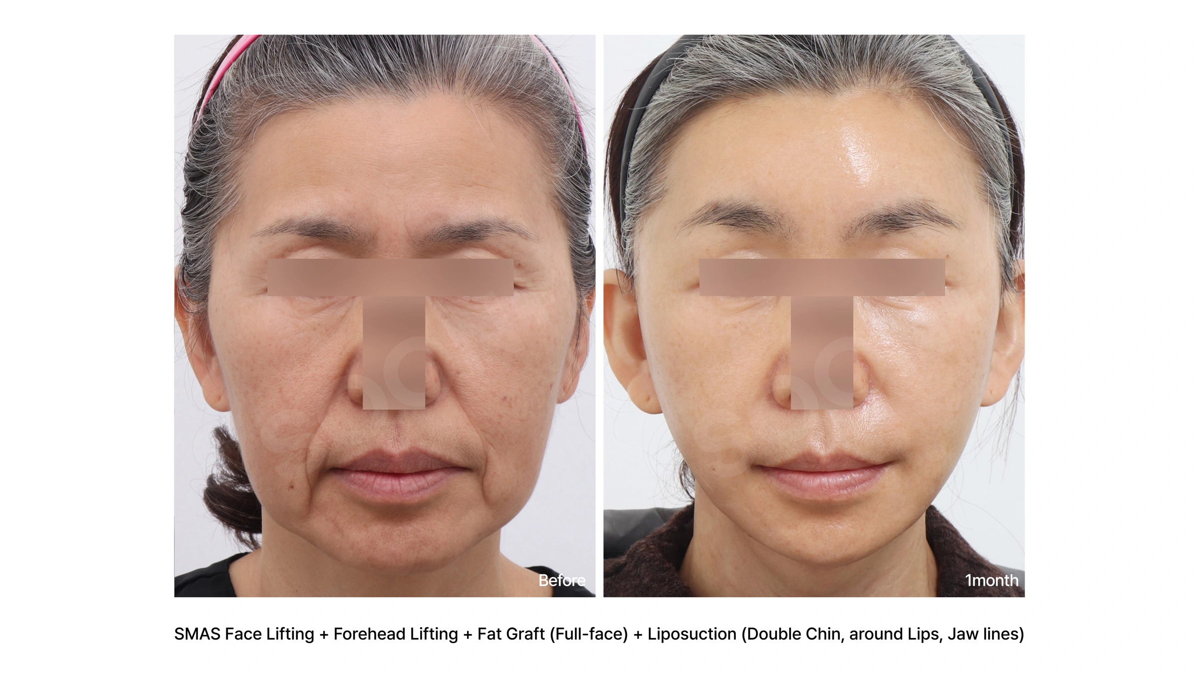 Facelift, forehead lift and facial liposuction at Soonplus Plastic Surgery. Soonplus Plastic Surgery, Seoul: facelift, forehead lift and facial liposuction, front facial views, with before on the left and after on the right. The source labels the follow-up as 1 month.
