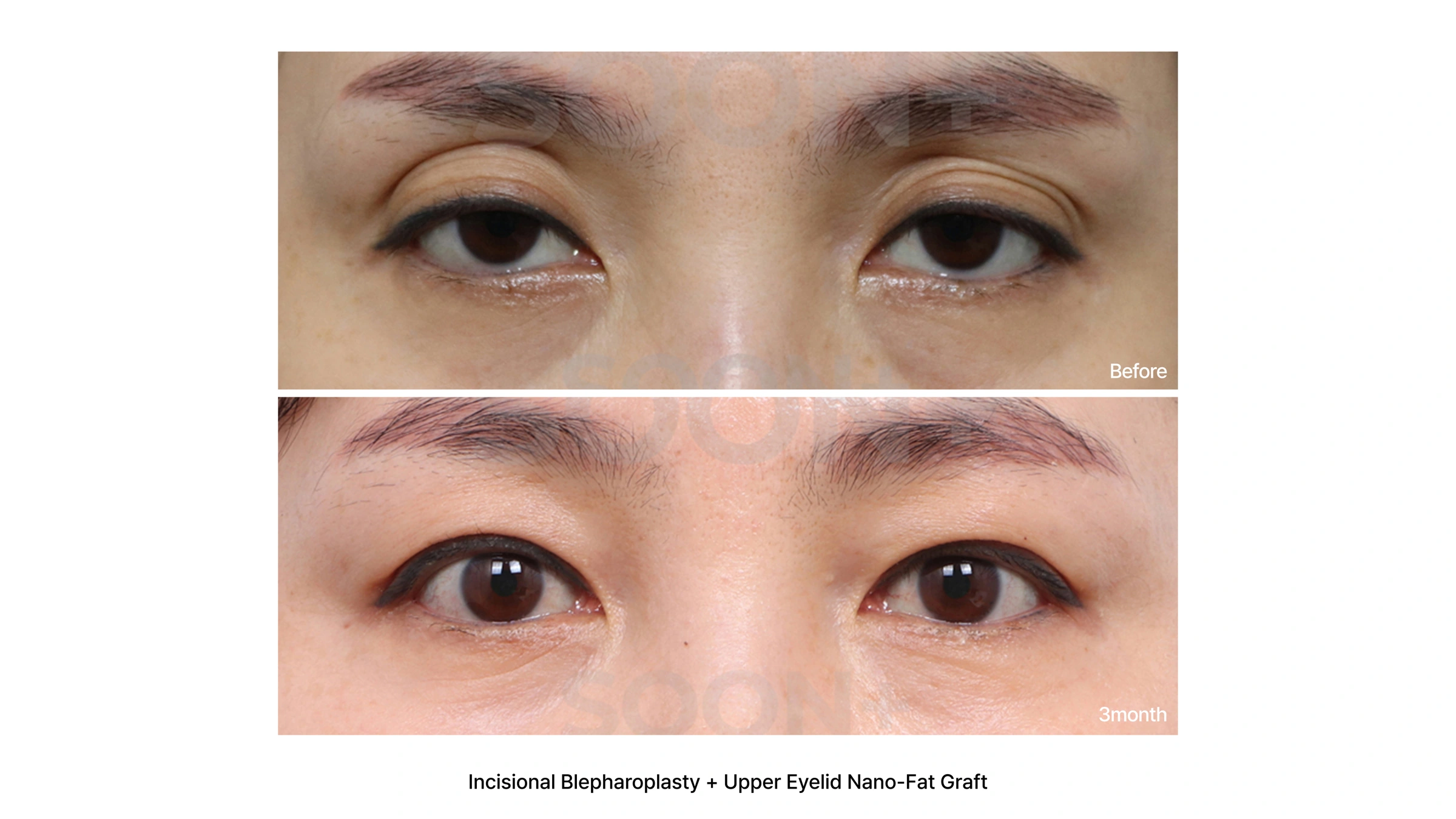 Incisional double-eyelid surgery with nano-fat grafting at Soonplus Plastic Surgery. Soonplus Plastic Surgery, Seoul: incisional double-eyelid surgery with nano-fat grafting, close-up eye views, with before above and after below. The source labels the follow-up as 3 months.