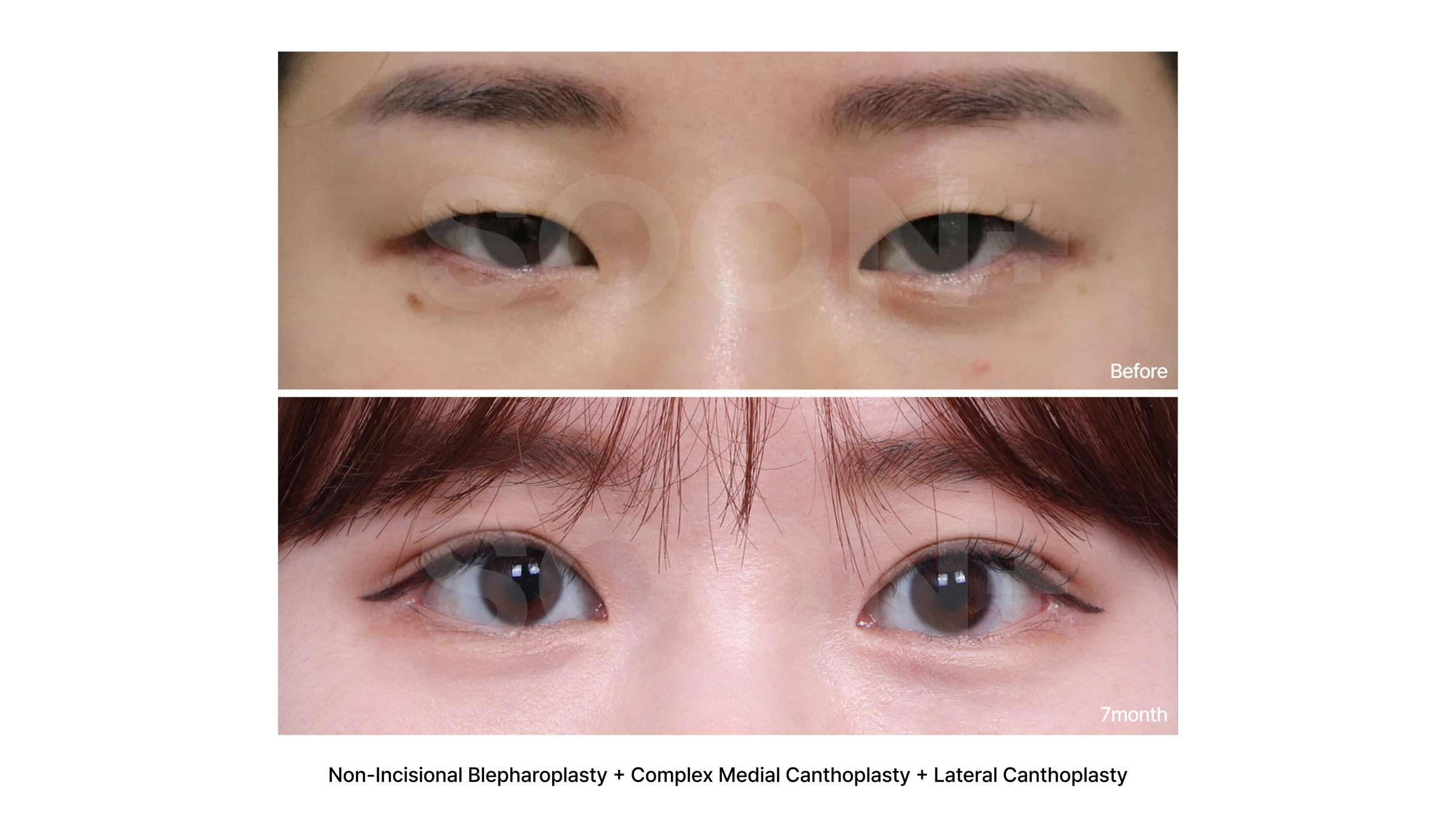Non-incisional double-eyelid surgery with canthoplasty at Soonplus Plastic Surgery. Soonplus Plastic Surgery, Seoul: non-incisional double-eyelid surgery with canthoplasty, close-up eye views, with before above and after below. The source labels the follow-up as 7 months.