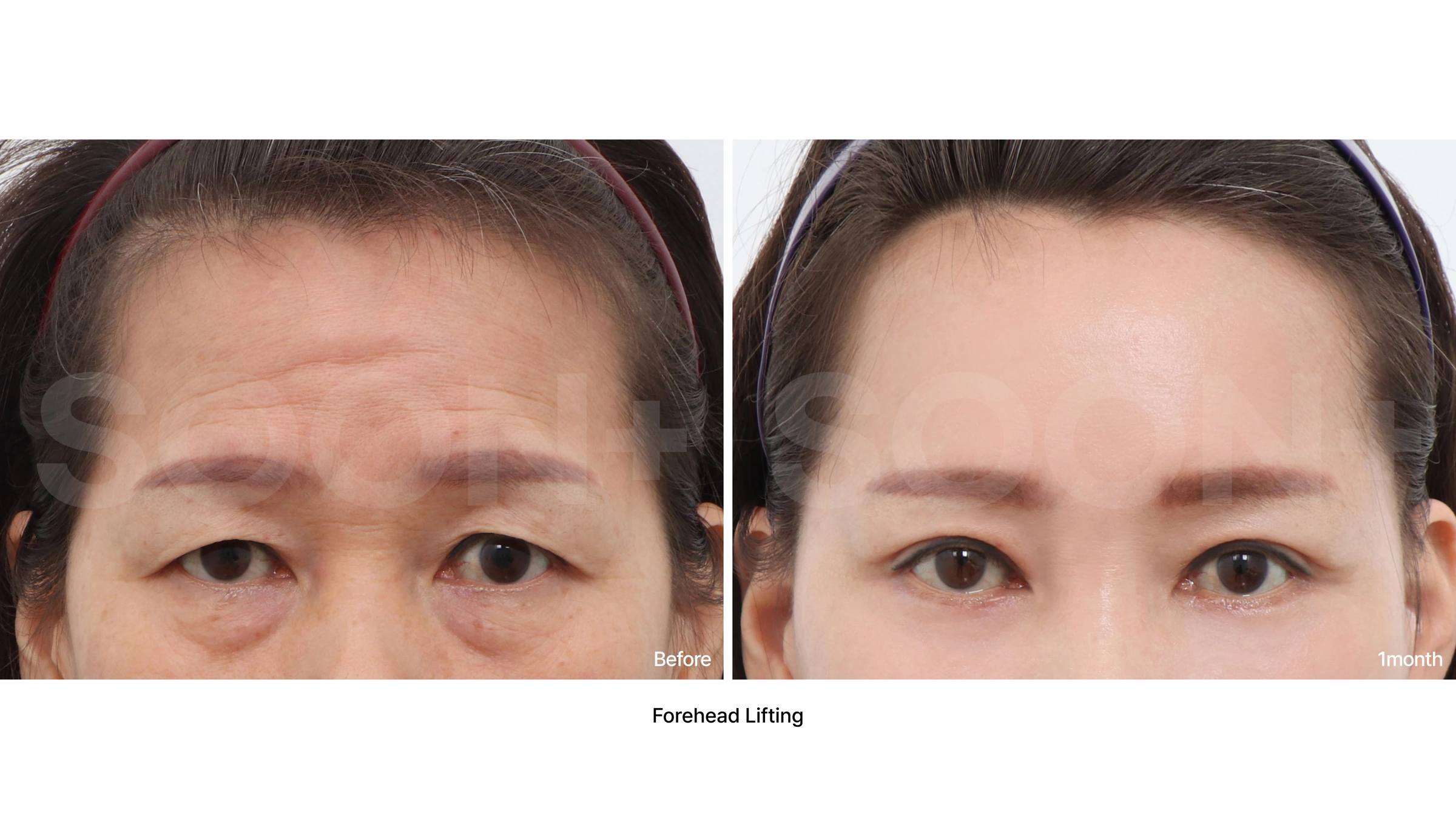 Forehead lift — upper-face comparison 03 at Soonplus Plastic Surgery. Soonplus Plastic Surgery, Seoul: forehead lift — upper-face comparison 03, upper-face views, with before on the left and after on the right. The source labels the follow-up as 1 month.