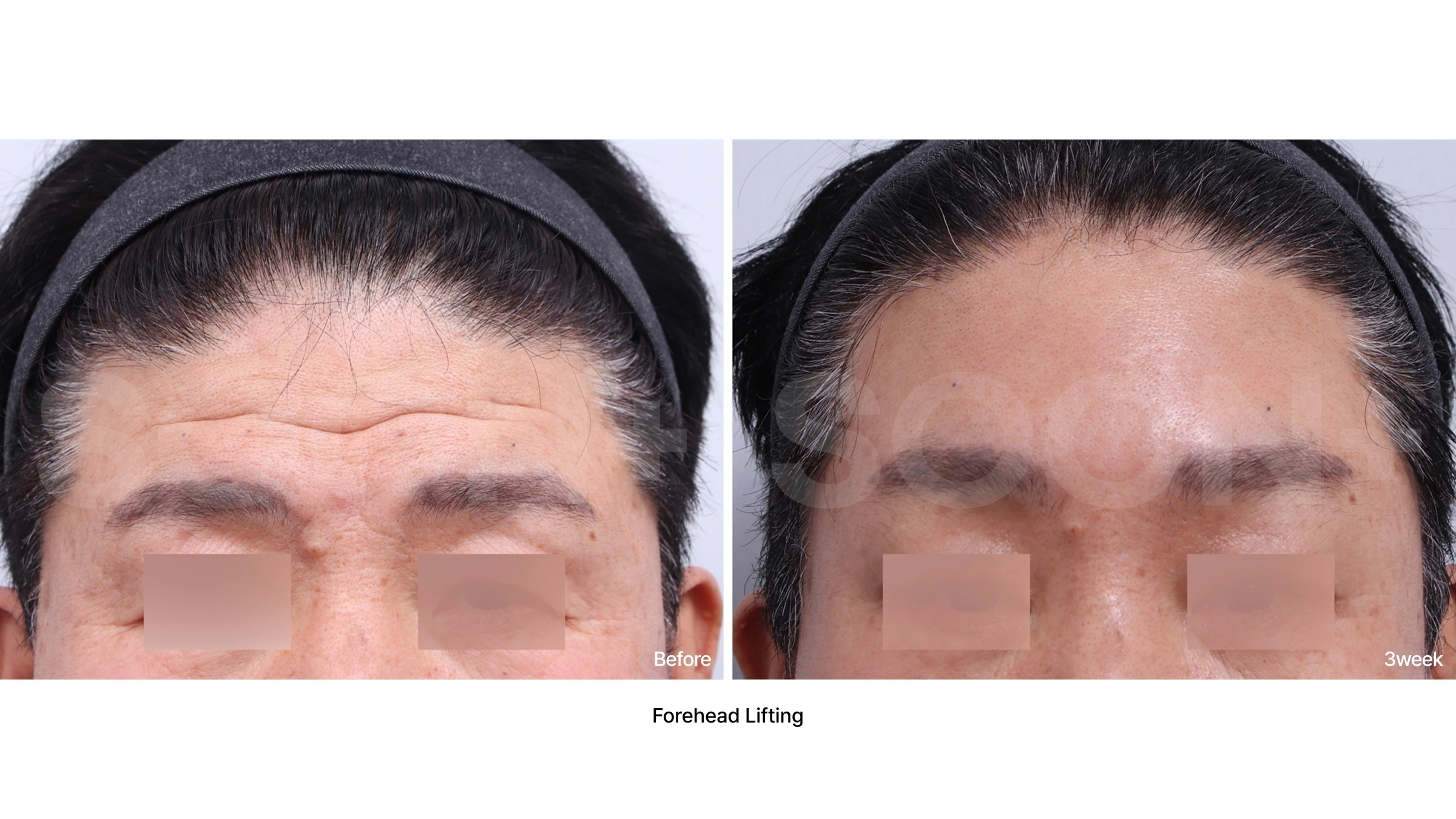 Forehead lift — upper-face comparison 04 at Soonplus Plastic Surgery. Soonplus Plastic Surgery, Seoul: forehead lift — upper-face comparison 04, upper-face views, with before on the left and after on the right. The source labels the follow-up as 3 weeks.