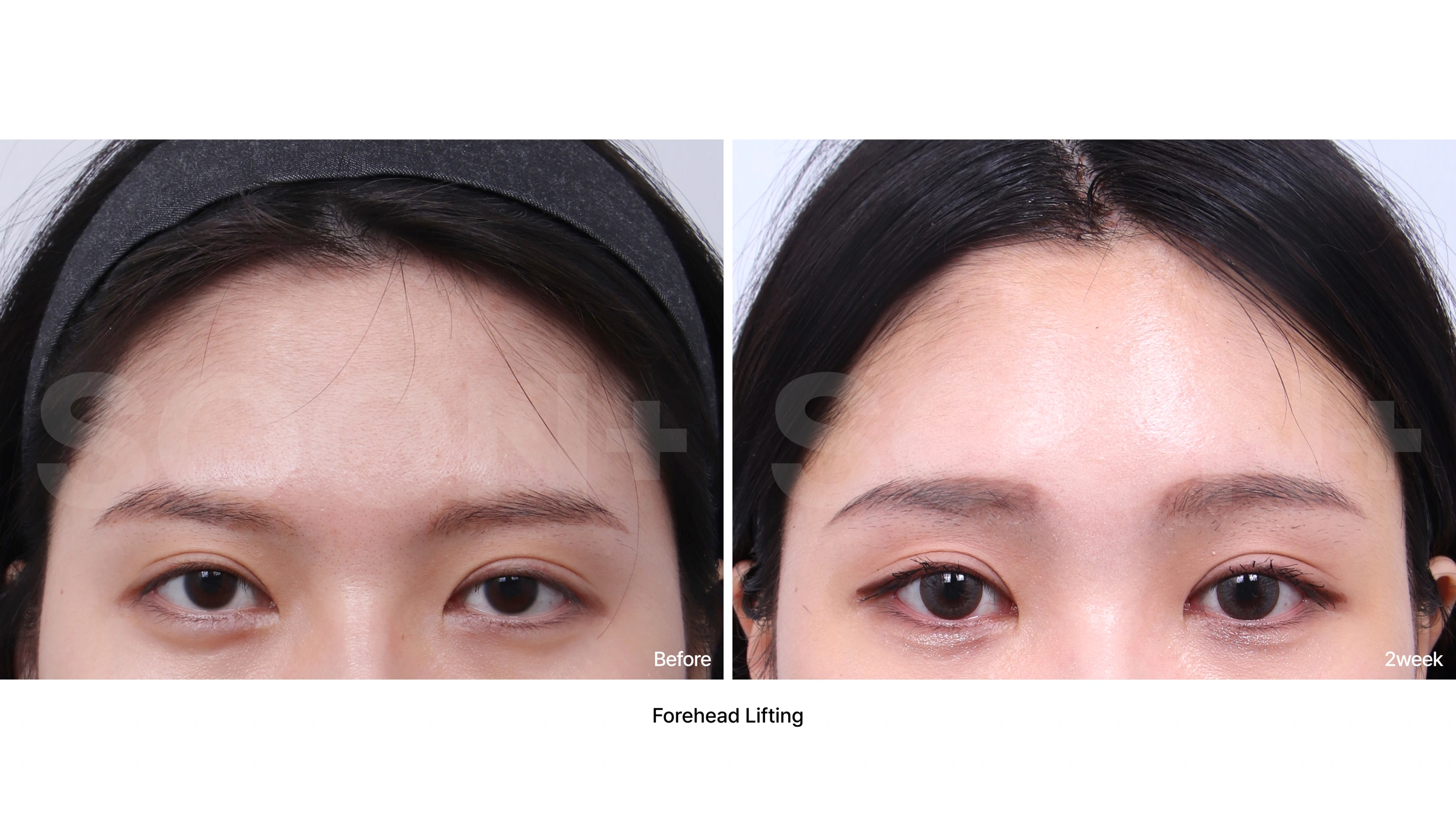 Forehead lift — upper-face comparison 05 at Soonplus Plastic Surgery. Soonplus Plastic Surgery, Seoul: forehead lift — upper-face comparison 05, upper-face views, with before on the left and after on the right. The source labels the follow-up as 2 weeks.